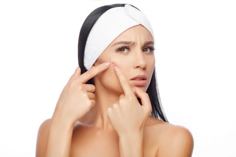 Avoid squeezing pimples, blackheads and comedones